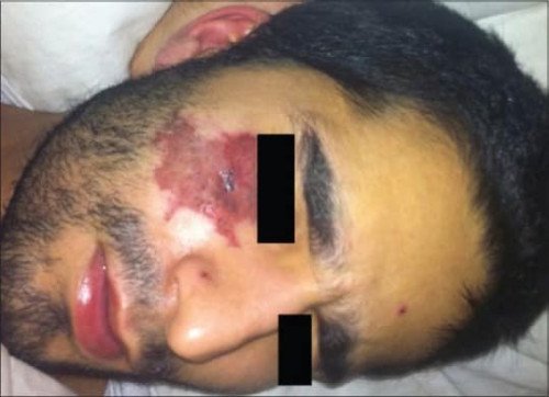 Sodium hypochlorite accident